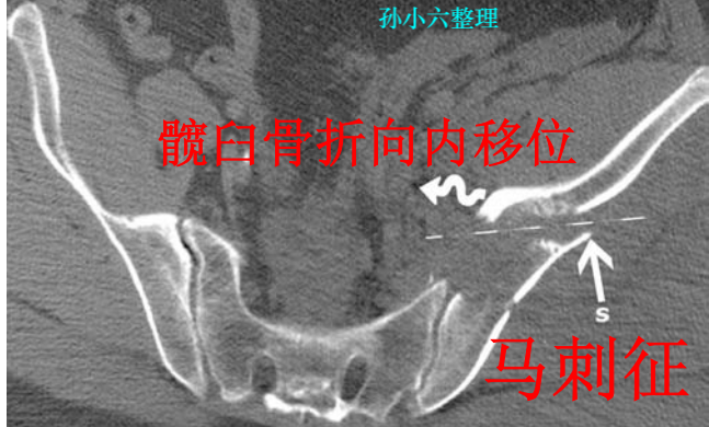 影像PPT - 马刺征、海鸥征、新月形、翻书样、风卷样骨折,这些特殊骨折征象你都见过吗?-2 影像PPT - 马刺征、海鸥征、新月形、翻书样、风卷样骨折,这些特殊骨折征象你都见过吗?-2