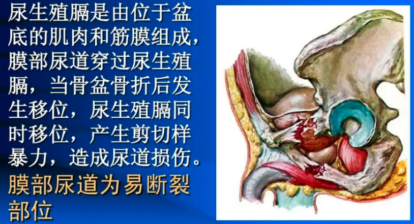 影像PPT - 马刺征、海鸥征、新月形、翻书样、风卷样骨折,这些特殊骨折征象你都见过吗?-7 影像PPT - 马刺征、海鸥征、新月形、翻书样、风卷样骨折,这些特殊骨折征象你都见过吗?-7