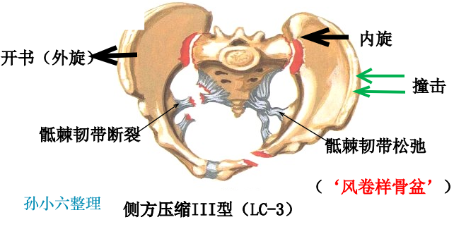影像PPT - 马刺征、海鸥征、新月形、翻书样、风卷样骨折,这些特殊骨折征象你都见过吗?-4 影像PPT - 马刺征、海鸥征、新月形、翻书样、风卷样骨折,这些特殊骨折征象你都见过吗?-4