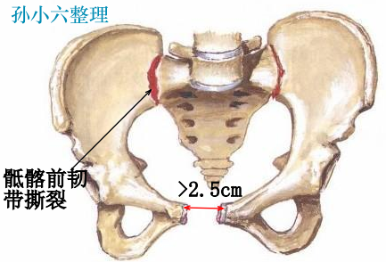 影像PPT - 马刺征、海鸥征、新月形、翻书样、风卷样骨折,这些特殊骨折征象你都见过吗?-5 影像PPT - 马刺征、海鸥征、新月形、翻书样、风卷样骨折,这些特殊骨折征象你都见过吗?-5