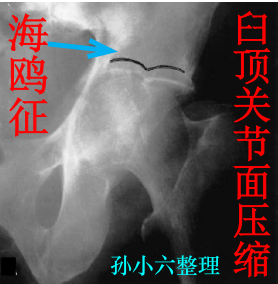 影像PPT - 马刺征、海鸥征、新月形、翻书样、风卷样骨折,这些特殊骨折征象你都见过吗?-1 影像PPT - 马刺征、海鸥征、新月形、翻书样、风卷样骨折,这些特殊骨折征象你都见过吗?-1