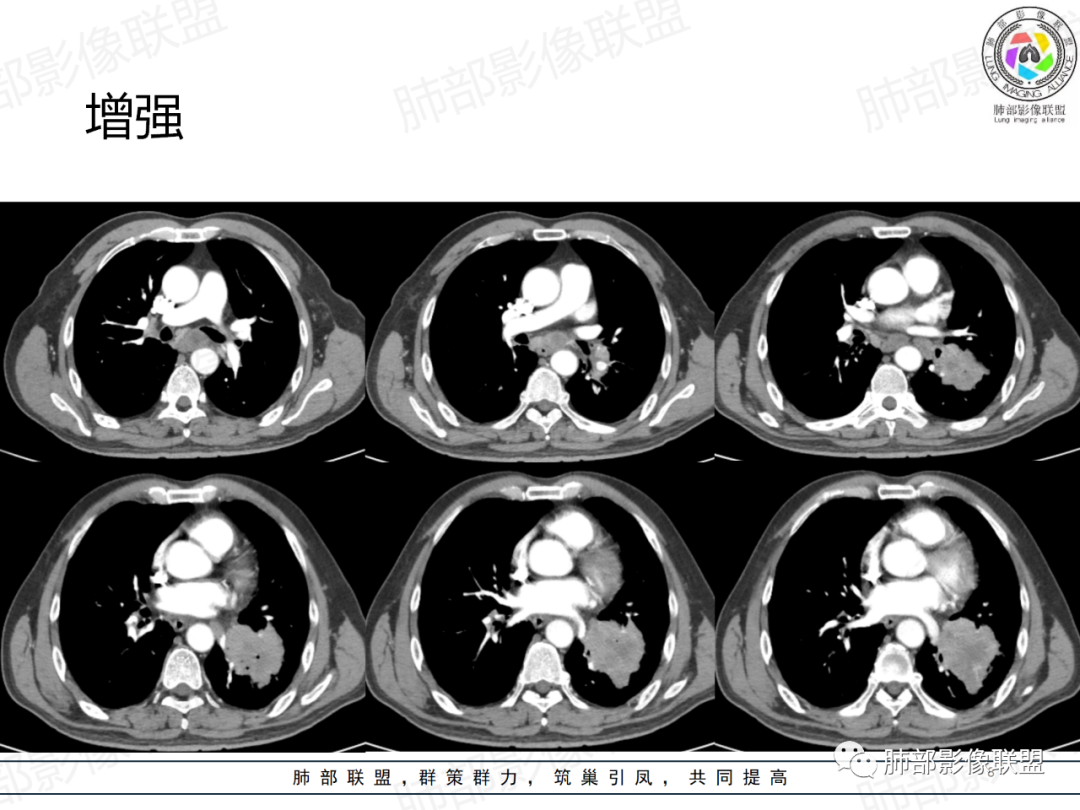 影像PPT - 【病例】肺门区团块影1例分析思路-8 影像PPT - 【病例】肺门区团块影1例分析思路-8