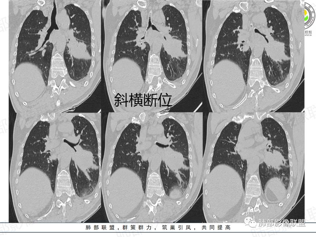 影像PPT - 【病例】肺门区团块影1例分析思路-10 影像PPT - 【病例】肺门区团块影1例分析思路-10
