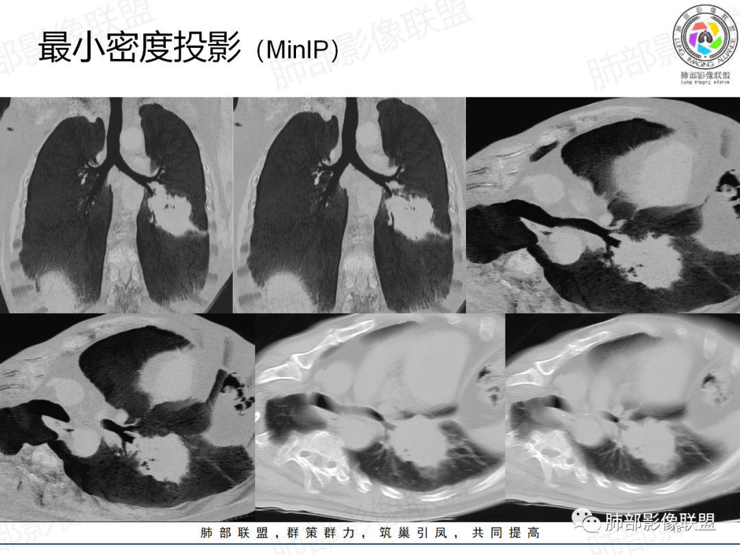 影像PPT - 【病例】肺门区团块影1例分析思路-13 影像PPT - 【病例】肺门区团块影1例分析思路-13