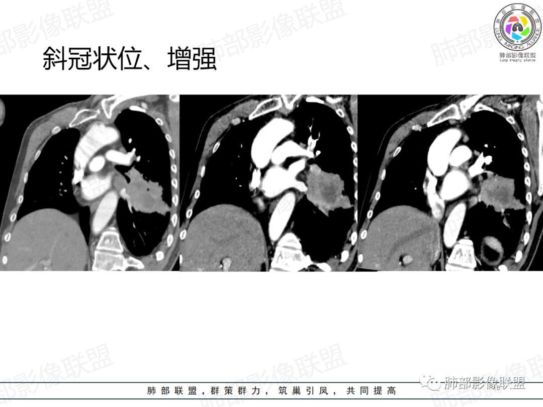 影像PPT - 【病例】肺门区团块影1例分析思路-15 影像PPT - 【病例】肺门区团块影1例分析思路-15