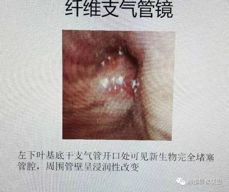 影像PPT - 【病例】肺门区团块影1例分析思路-23 影像PPT - 【病例】肺门区团块影1例分析思路-23
