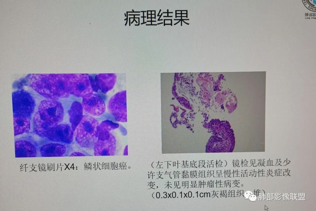 影像PPT - 【病例】肺门区团块影1例分析思路-24 影像PPT - 【病例】肺门区团块影1例分析思路-24