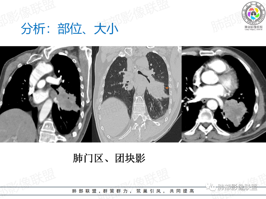 影像PPT - 【病例】肺门区团块影1例分析思路-29 影像PPT - 【病例】肺门区团块影1例分析思路-29
