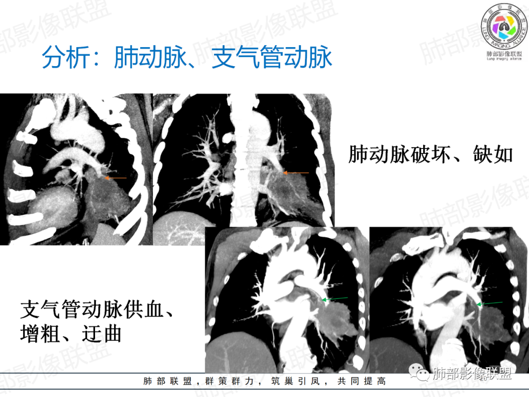 影像PPT - 【病例】肺门区团块影1例分析思路-33 影像PPT - 【病例】肺门区团块影1例分析思路-33