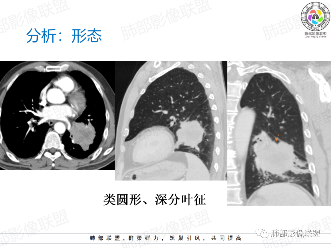影像PPT - 【病例】肺门区团块影1例分析思路-30 影像PPT - 【病例】肺门区团块影1例分析思路-30