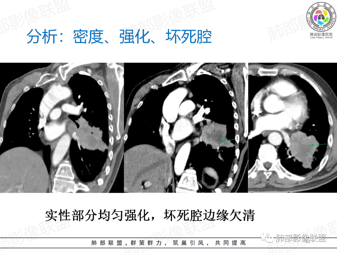 影像PPT - 【病例】肺门区团块影1例分析思路-35 影像PPT - 【病例】肺门区团块影1例分析思路-35