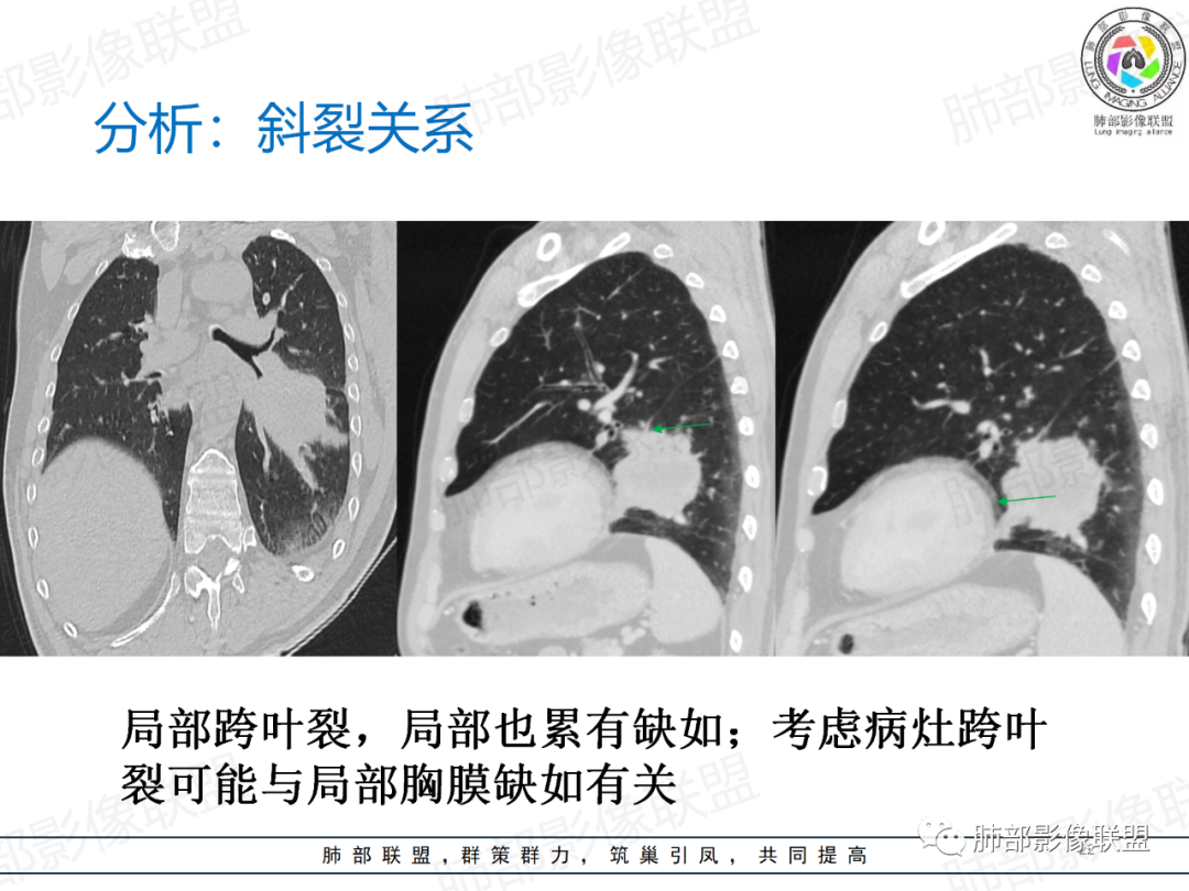 影像PPT - 【病例】肺门区团块影1例分析思路-34 影像PPT - 【病例】肺门区团块影1例分析思路-34