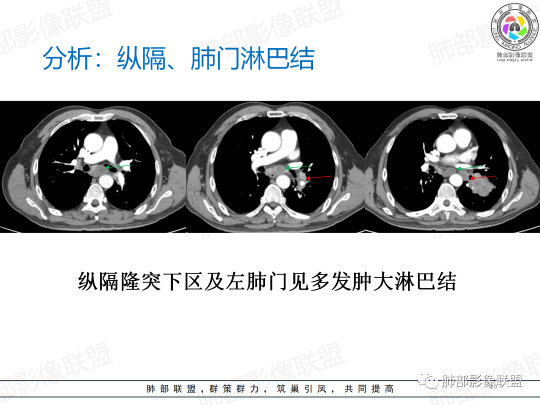 影像PPT - 【病例】肺门区团块影1例分析思路-36 影像PPT - 【病例】肺门区团块影1例分析思路-36