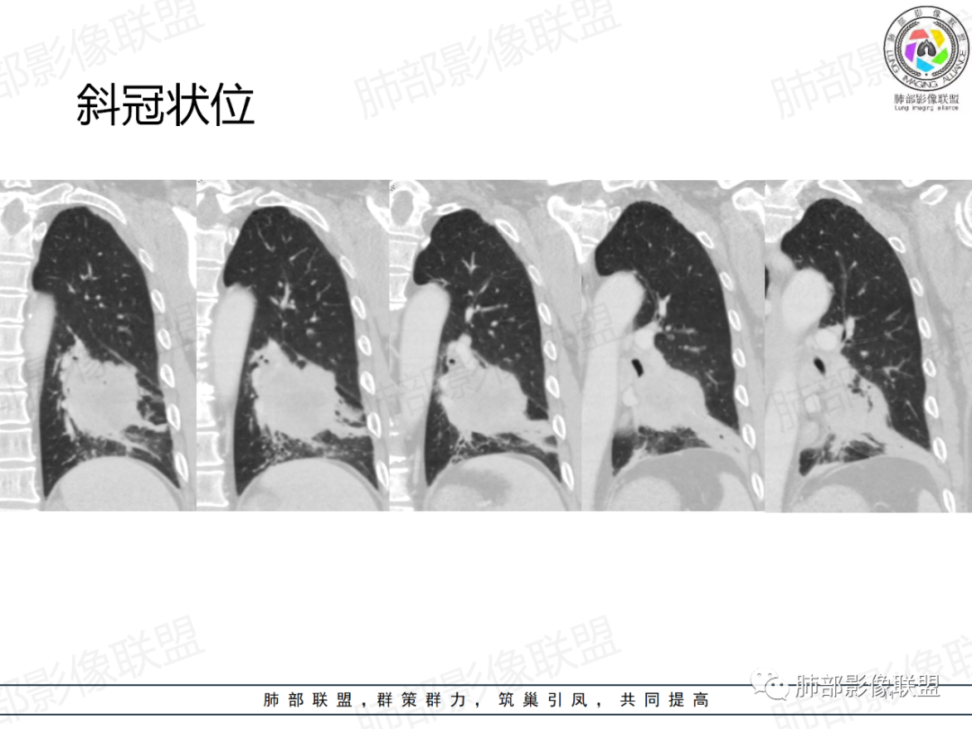 影像PPT - 【病例】肺门区团块影1例分析思路-11 影像PPT - 【病例】肺门区团块影1例分析思路-11