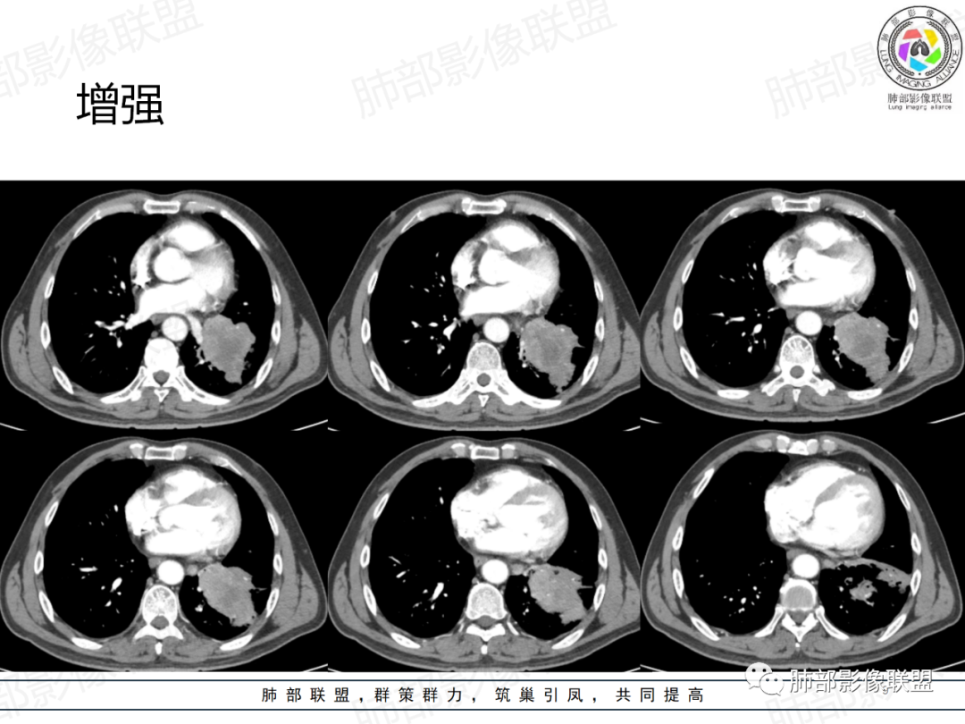 影像PPT - 【病例】肺门区团块影1例分析思路-9 影像PPT - 【病例】肺门区团块影1例分析思路-9