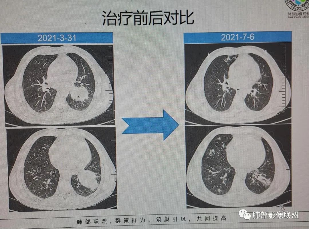 影像PPT - 【病例】肺门区团块影1例分析思路-26 影像PPT - 【病例】肺门区团块影1例分析思路-26