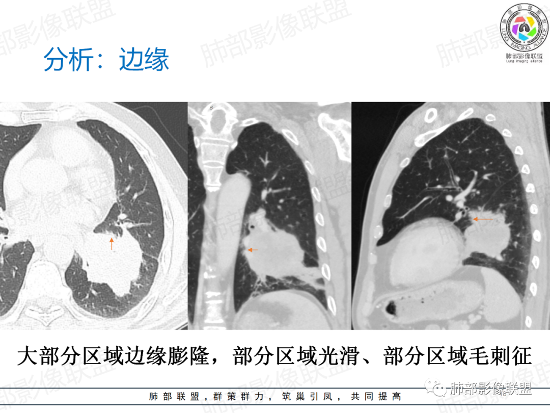 影像PPT - 【病例】肺门区团块影1例分析思路-31 影像PPT - 【病例】肺门区团块影1例分析思路-31