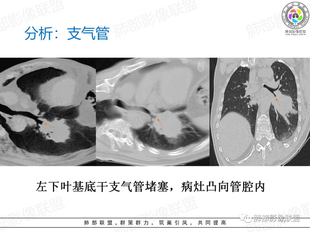 影像PPT - 【病例】肺门区团块影1例分析思路-32 影像PPT - 【病例】肺门区团块影1例分析思路-32