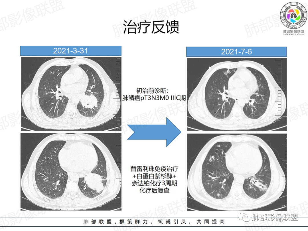 影像PPT - 【病例】肺门区团块影1例分析思路-40 影像PPT - 【病例】肺门区团块影1例分析思路-40