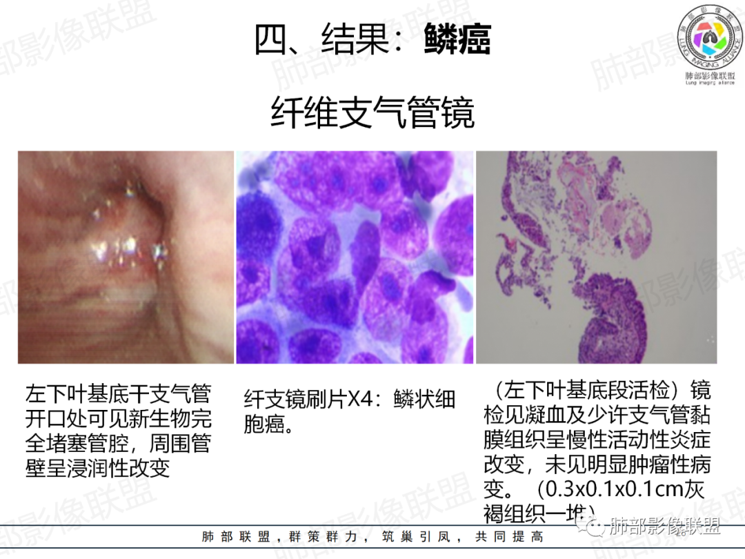 影像PPT - 【病例】肺门区团块影1例分析思路-39 影像PPT - 【病例】肺门区团块影1例分析思路-39