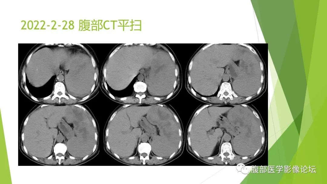 影像PPT - 【病例】脾脏弥漫大B细胞淋巴瘤1例CT及MR影像-5