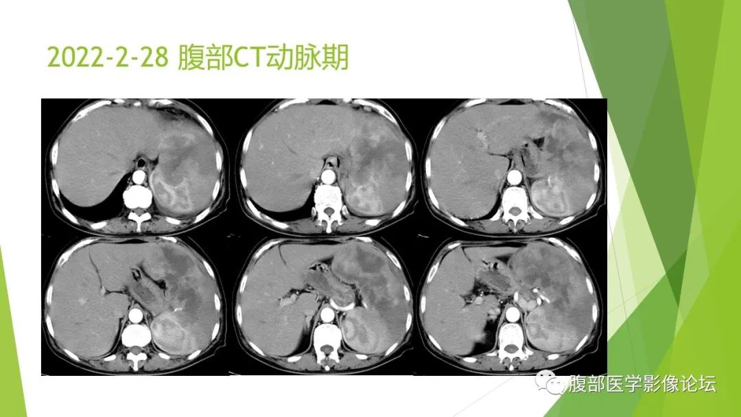 影像PPT - 【病例】脾脏弥漫大B细胞淋巴瘤1例CT及MR影像-7