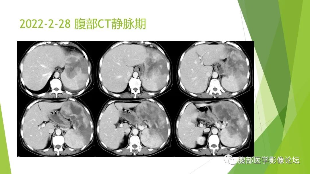 影像PPT - 【病例】脾脏弥漫大B细胞淋巴瘤1例CT及MR影像-9