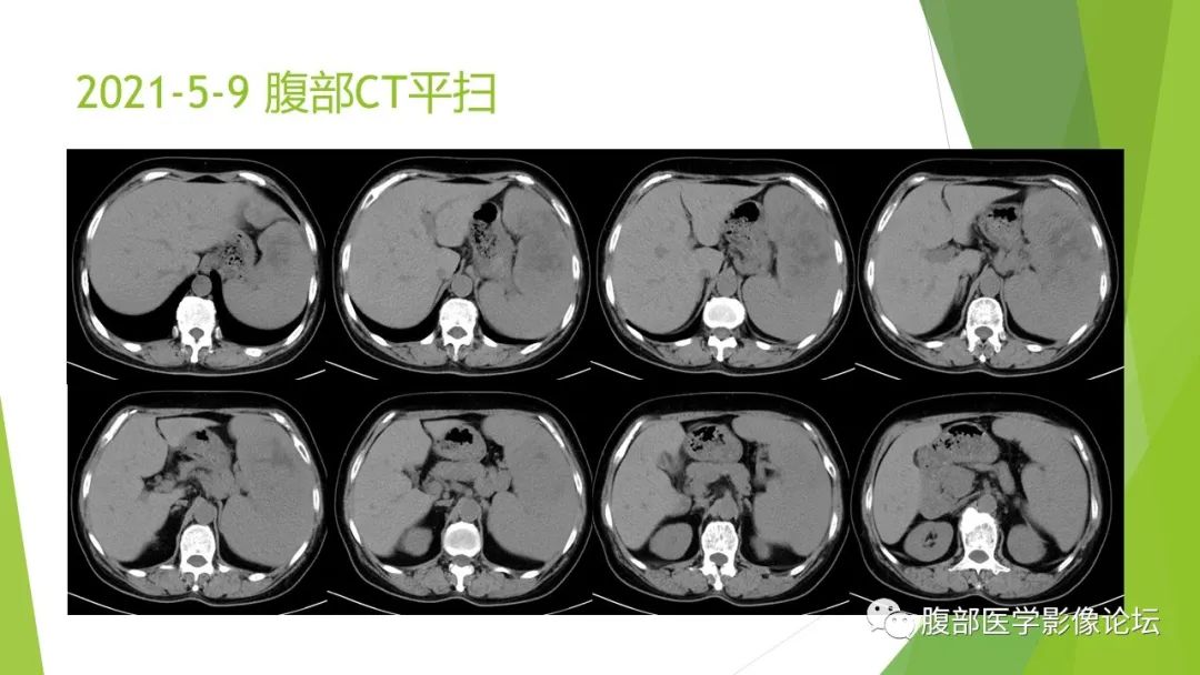 影像PPT - 【病例】脾脏弥漫大B细胞淋巴瘤1例CT及MR影像-3