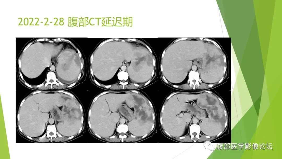 影像PPT - 【病例】脾脏弥漫大B细胞淋巴瘤1例CT及MR影像-11