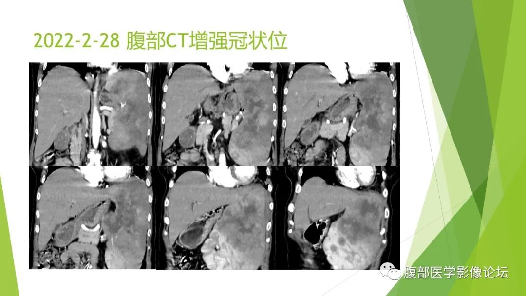 影像PPT - 【病例】脾脏弥漫大B细胞淋巴瘤1例CT及MR影像-13