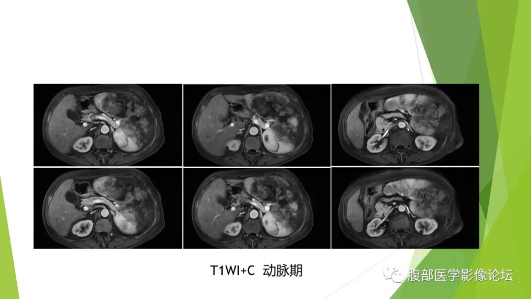 影像PPT - 【病例】脾脏弥漫大B细胞淋巴瘤1例CT及MR影像-22