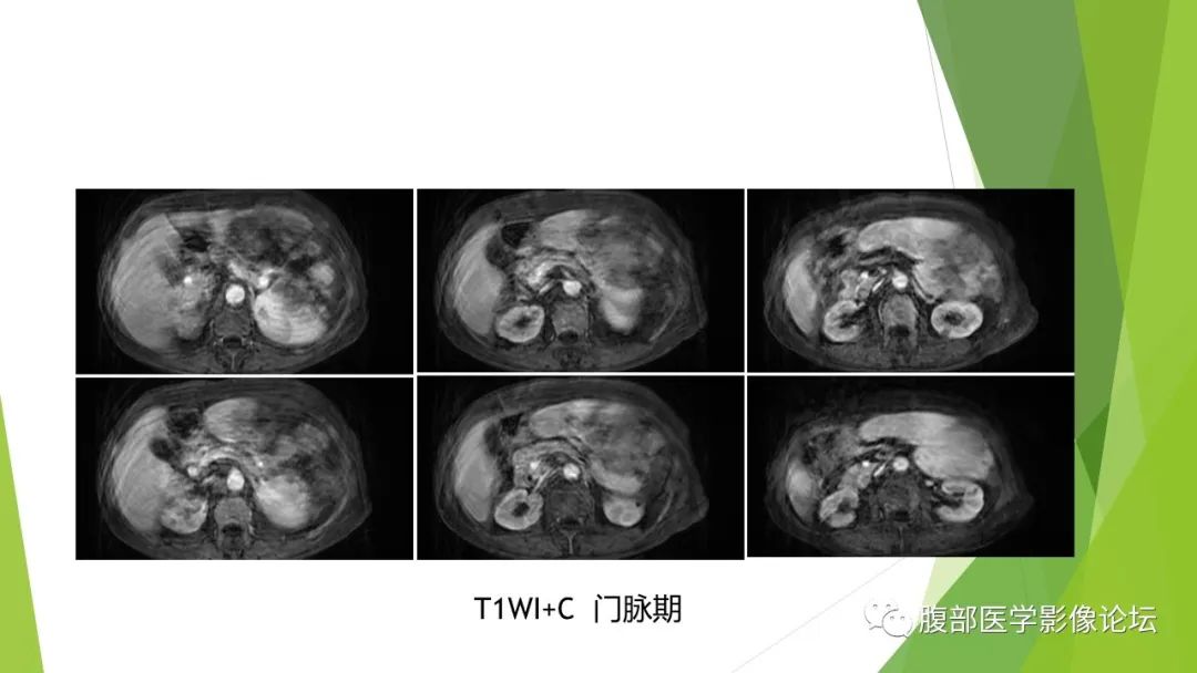 影像PPT - 【病例】脾脏弥漫大B细胞淋巴瘤1例CT及MR影像-24