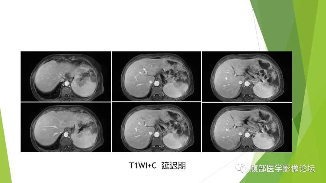 影像PPT - 【病例】脾脏弥漫大B细胞淋巴瘤1例CT及MR影像-25