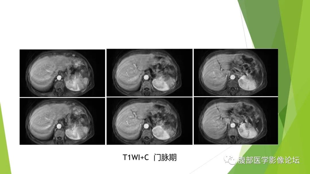 影像PPT - 【病例】脾脏弥漫大B细胞淋巴瘤1例CT及MR影像-23