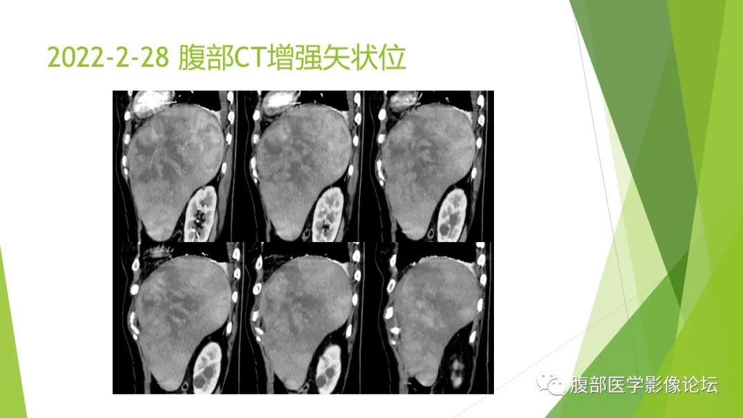 影像PPT - 【病例】脾脏弥漫大B细胞淋巴瘤1例CT及MR影像-14