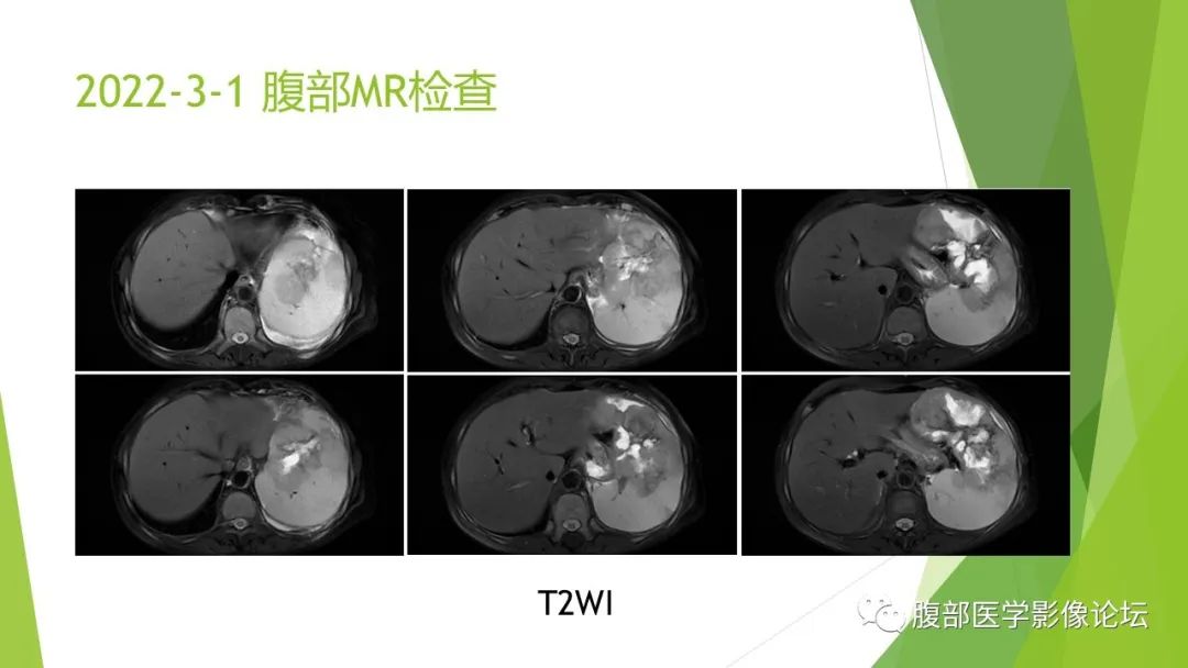 影像PPT - 【病例】脾脏弥漫大B细胞淋巴瘤1例CT及MR影像-15