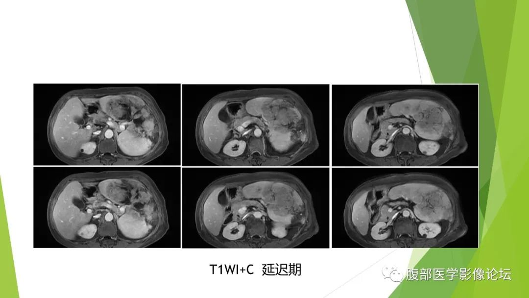 影像PPT - 【病例】脾脏弥漫大B细胞淋巴瘤1例CT及MR影像-26