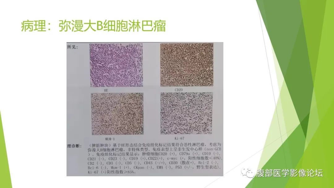 影像PPT - 【病例】脾脏弥漫大B细胞淋巴瘤1例CT及MR影像-29