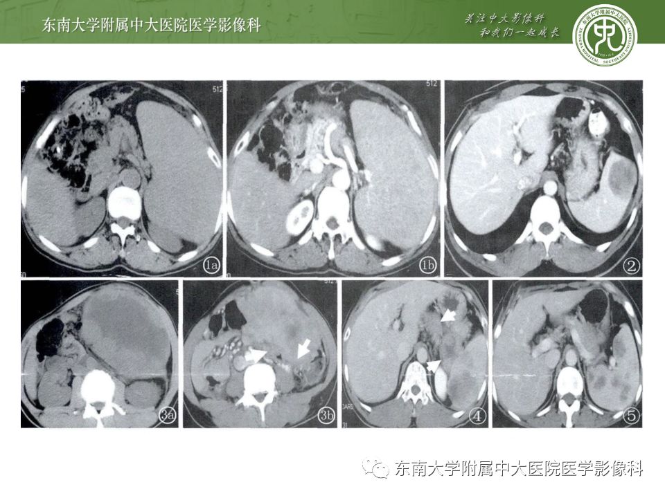 影像PPT - 【病例】脾脏弥漫大B细胞淋巴瘤1例CT及MR影像-34