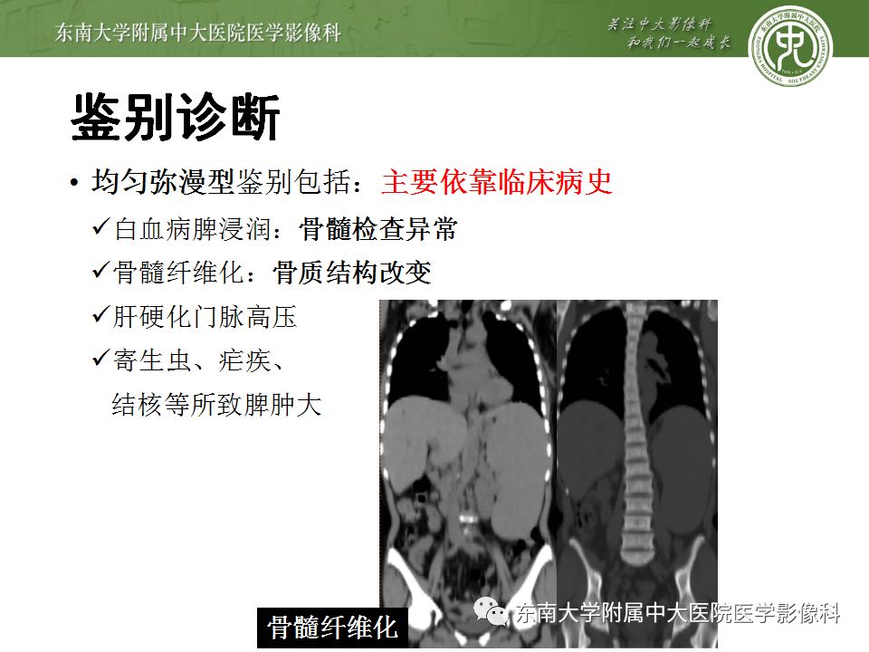 影像PPT - 【病例】脾脏弥漫大B细胞淋巴瘤1例CT及MR影像-35