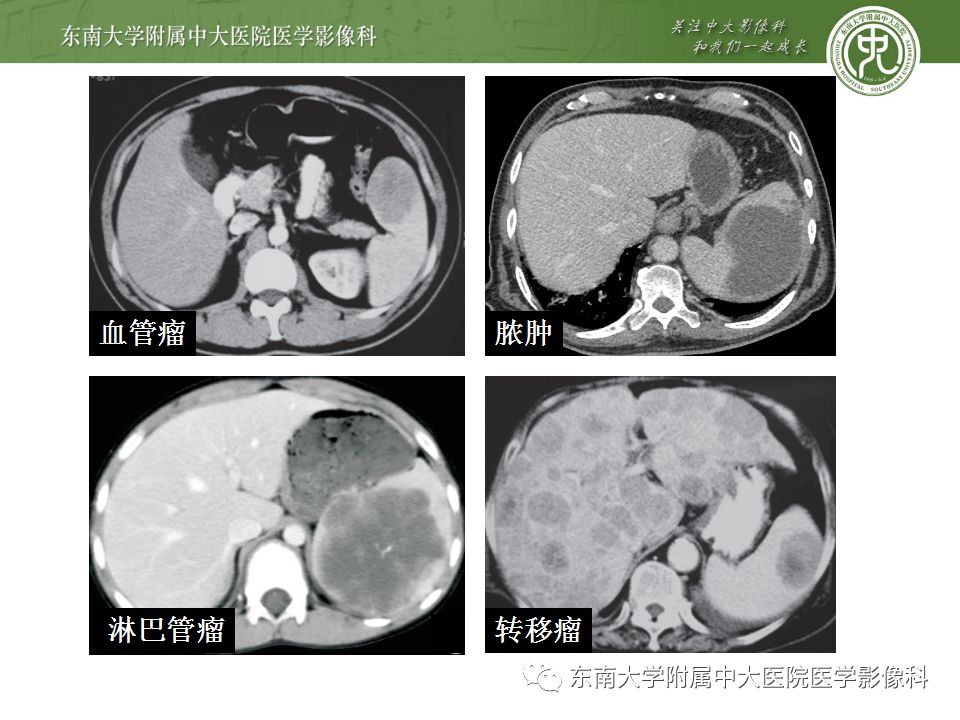 影像PPT - 【病例】脾脏弥漫大B细胞淋巴瘤1例CT及MR影像-39