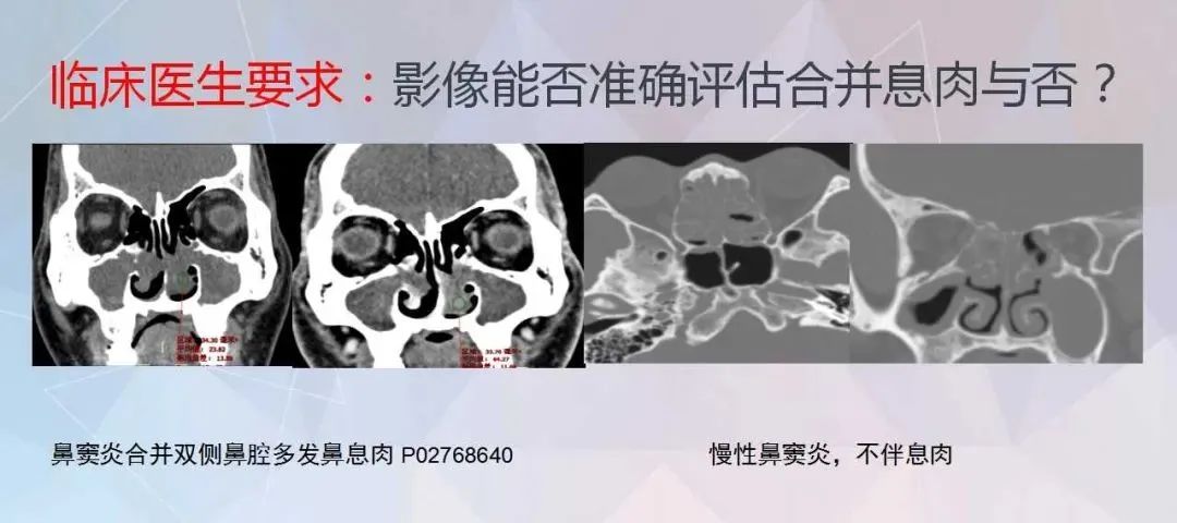 影像PPT - 【PPT】鼻窦CT评估与结构式报告-3