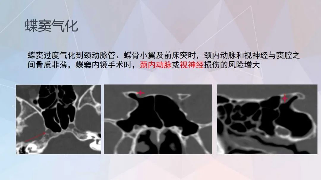 影像PPT - 【PPT】鼻窦CT评估与结构式报告-14