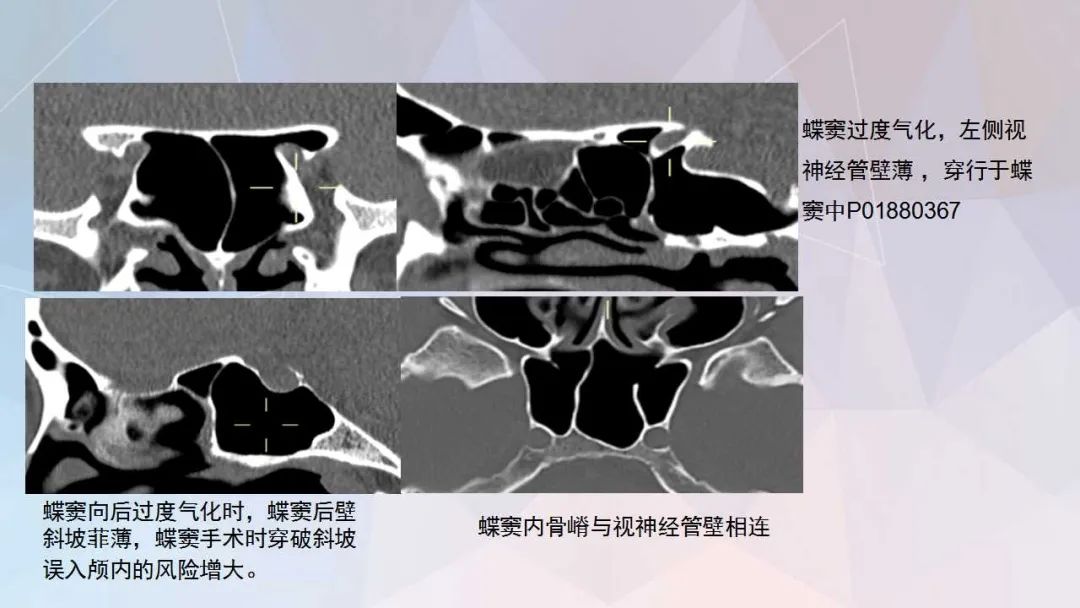 影像PPT - 【PPT】鼻窦CT评估与结构式报告-15