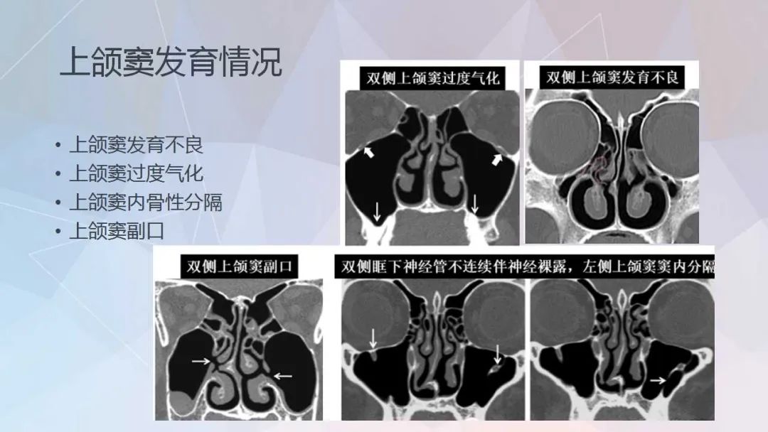 影像PPT - 【PPT】鼻窦CT评估与结构式报告-16