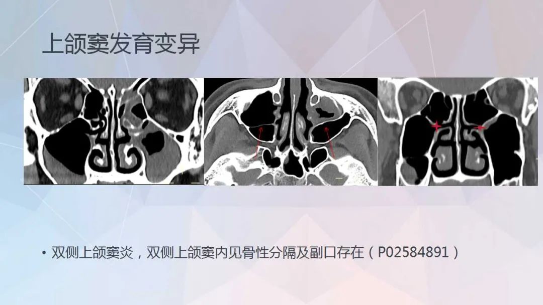 影像PPT - 【PPT】鼻窦CT评估与结构式报告-17
