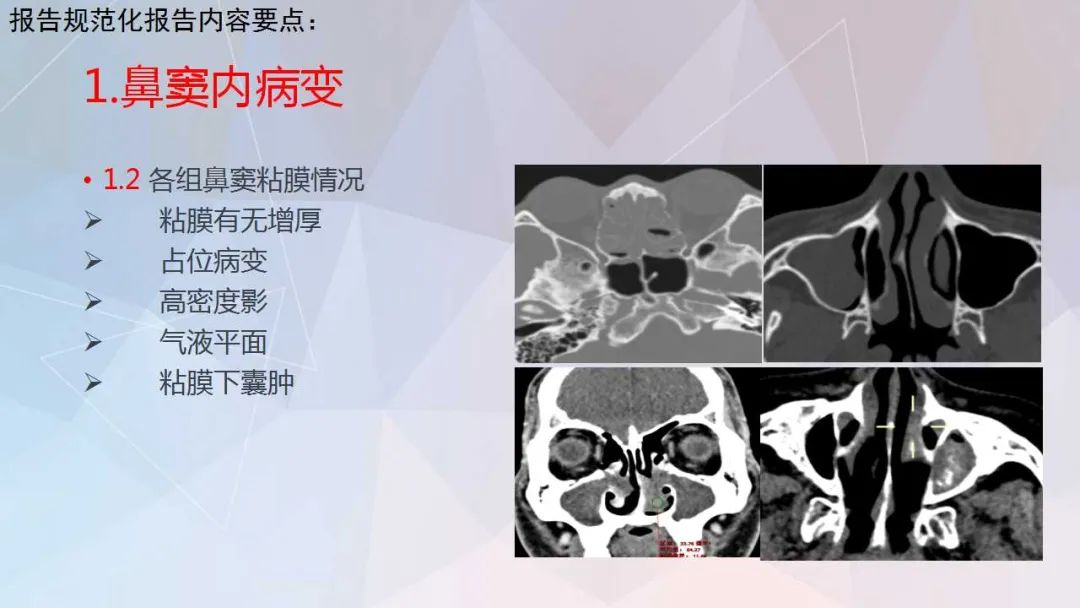影像PPT - 【PPT】鼻窦CT评估与结构式报告-18