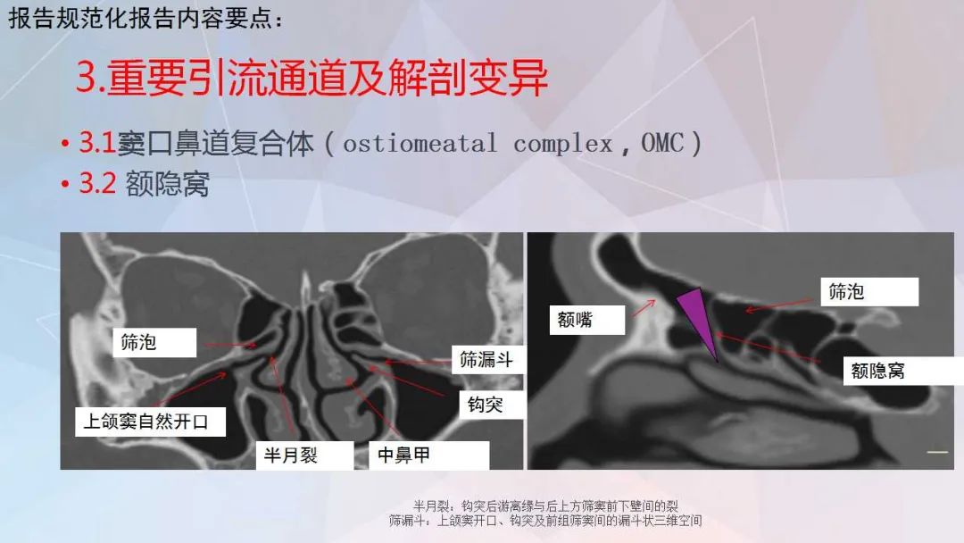 影像PPT - 【PPT】鼻窦CT评估与结构式报告-20