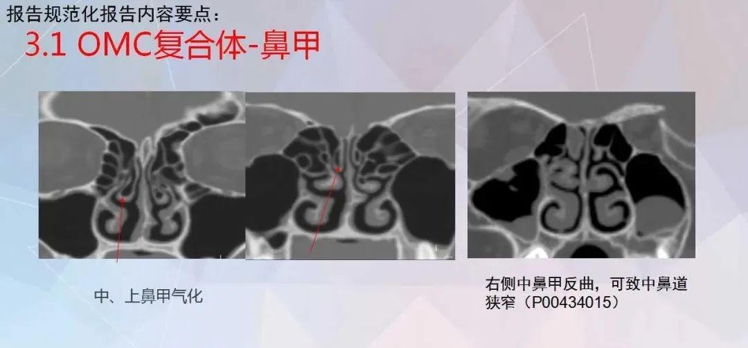 影像PPT - 【PPT】鼻窦CT评估与结构式报告-24
