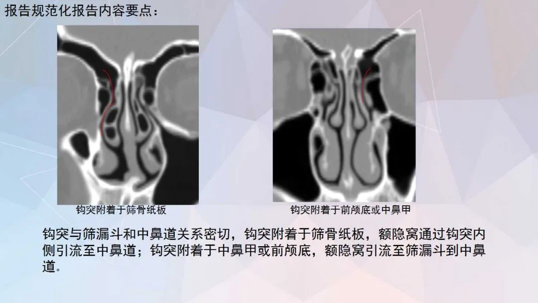影像PPT - 【PPT】鼻窦CT评估与结构式报告-27